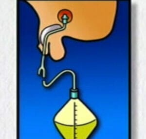 Closed Urinary Drainage System