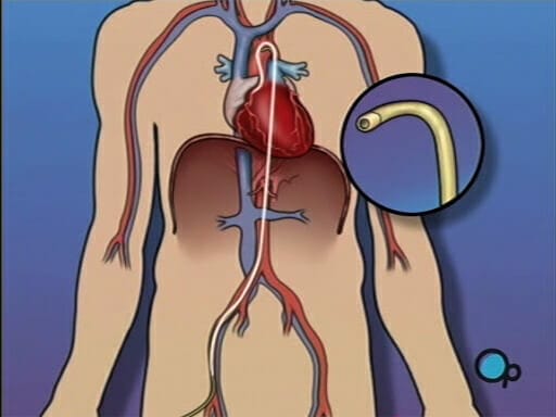 Cardiac Catheterization (Angiography)