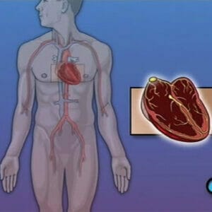 Permanent Pacemaker Implant