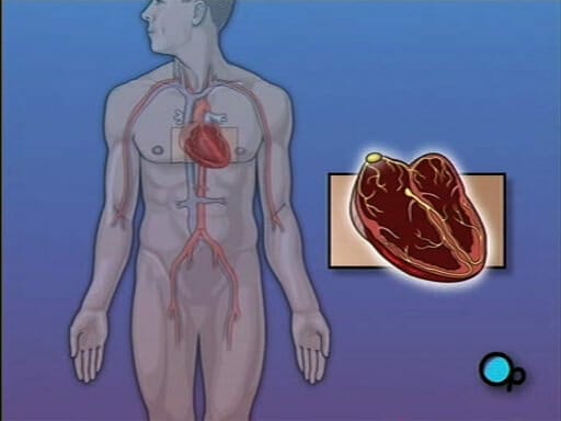 Permanent Pacemaker Implant