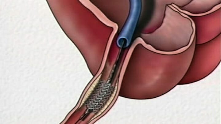 Stent Implantation (Angioplasty) - Image 2