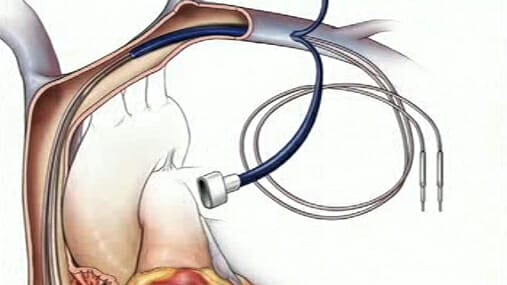 Permanent Pacemaker Implantation - Image 2
