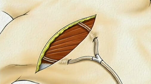 403_surgery