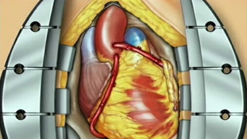 Coronary Artery Bypass Graft (CABG Off-Pump) - Image 2