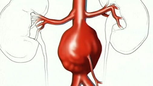 Abdominal Aortic Aneurysm (AAA) - Image 2